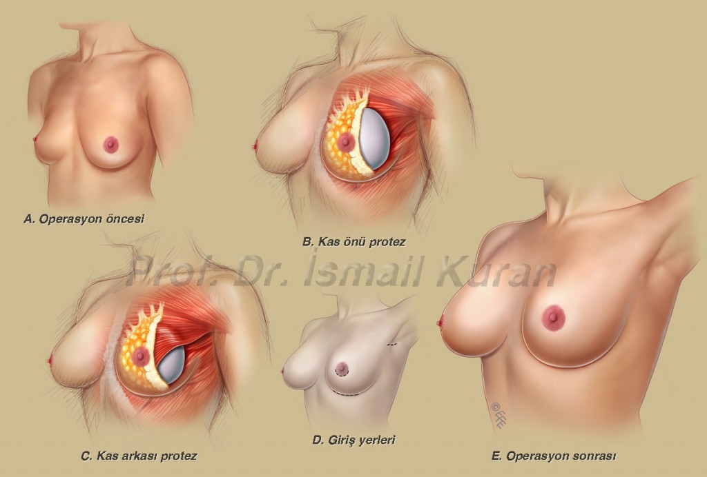 Breast augmentation